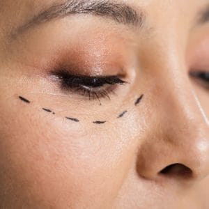 Blefaroplastia (Cirugía de Párpados) superior